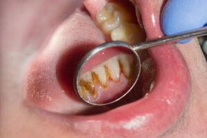 how to remove plaque from teeth naturally